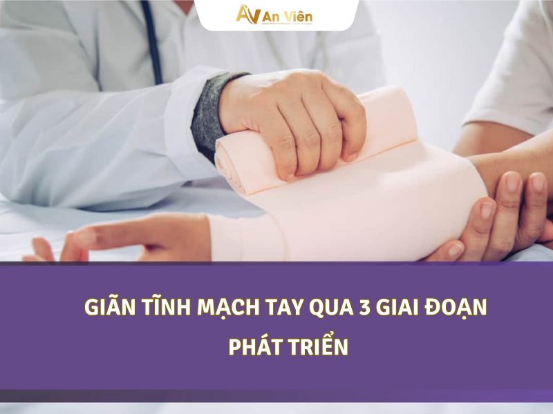 dấu hiệu giãn tĩnh mạch tay