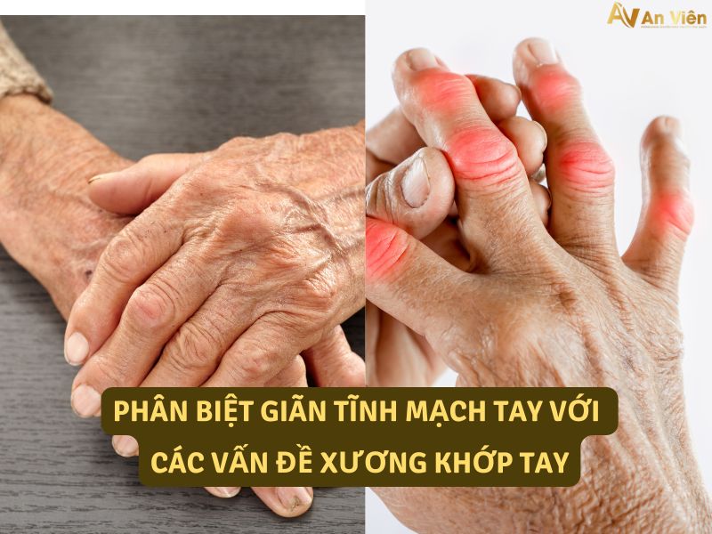 dấu hiệu giãn tĩnh mạch tay