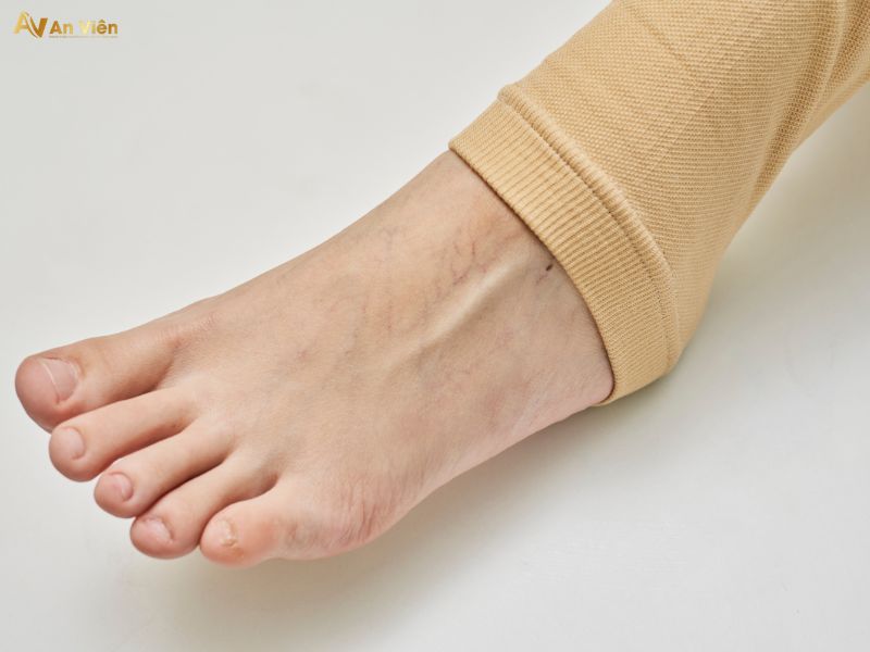 giá vớ y khoa suy giãn tĩnh mạch