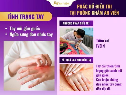 cách chữa suy giãn tĩnh mạch tay