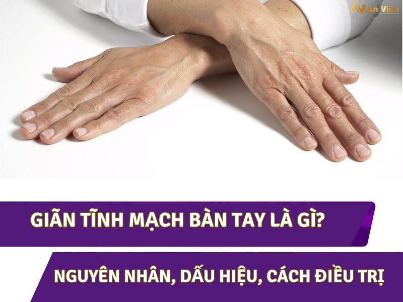 giãn tĩnh mạch bàn tay