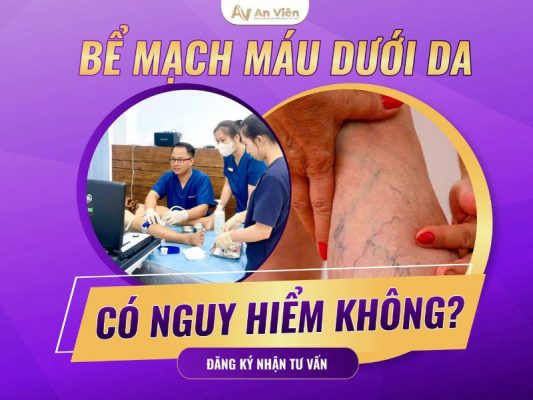 giãn tĩnh mạch khoeo chân