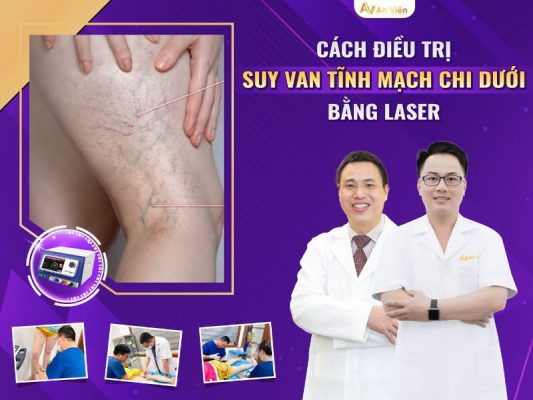 giãn tĩnh mạch khoeo chân