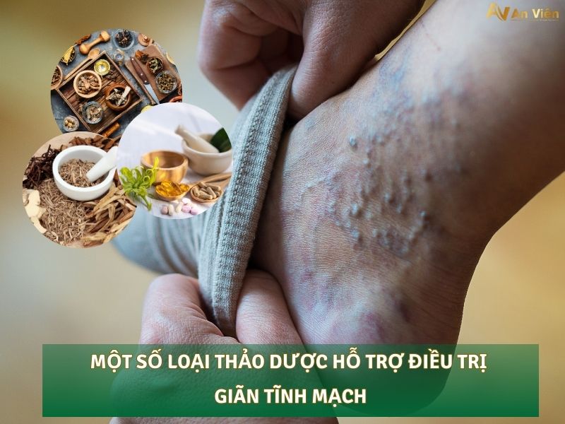 lá lốt chữa giãn tĩnh mạch