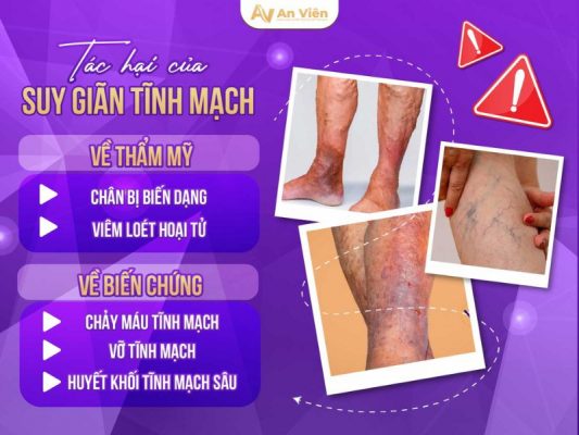 massage giãn tĩnh mạch