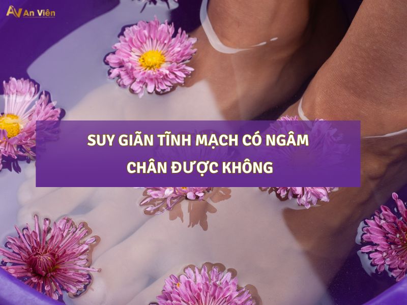 suy giãn tĩnh mạch có ngâm chân được không