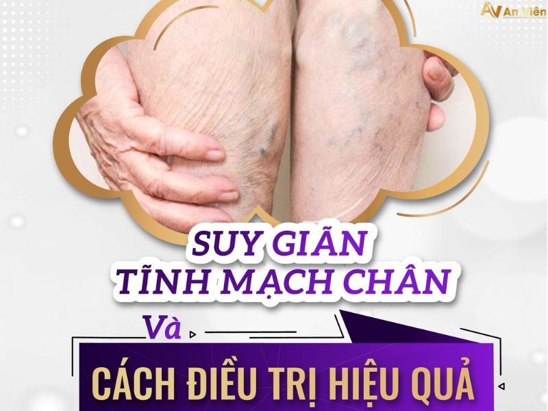 suy giãn tĩnh mạch có ngâm chân được không