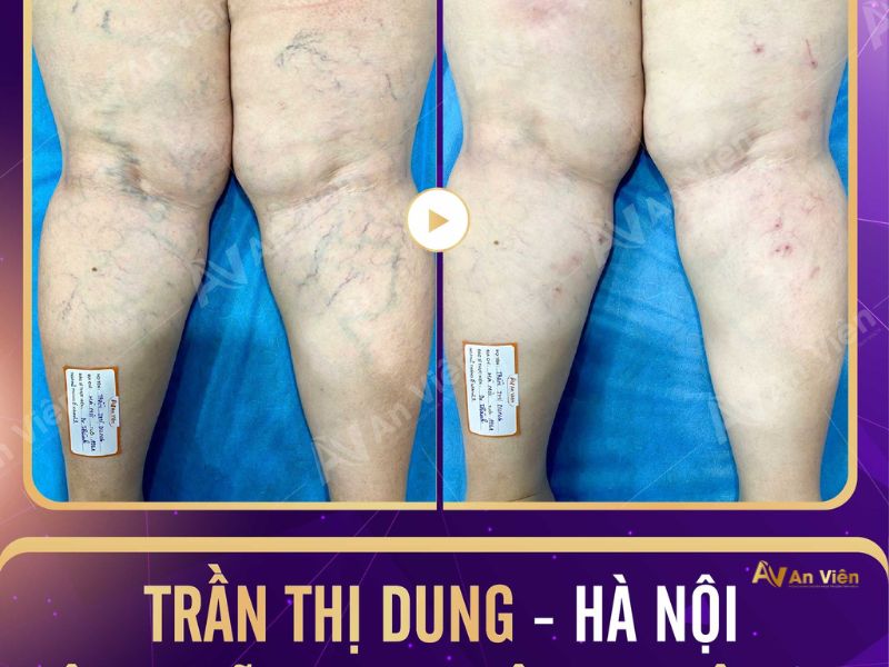 suy giãn tĩnh mạch có ngâm chân được không