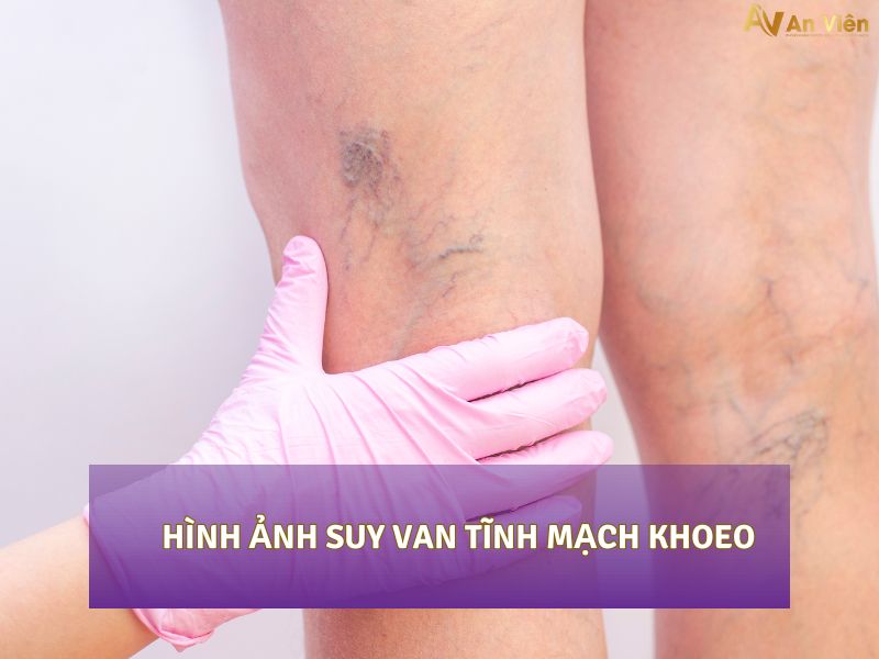 suy van tĩnh mạch khoeo
