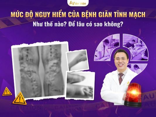 dấu hiệu giãn tĩnh mạch
