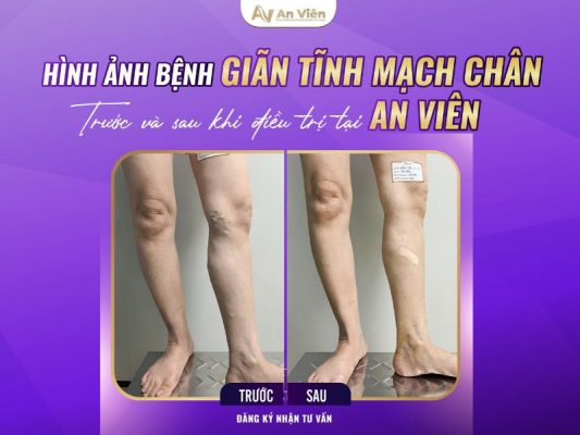 đốt laser giãn tĩnh mạch chân