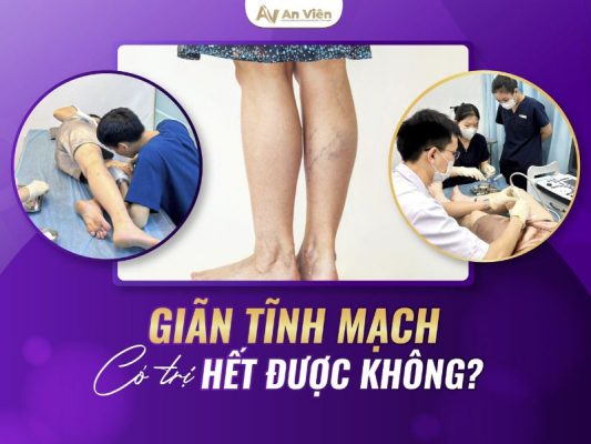 đốt laser giãn tĩnh mạch chân