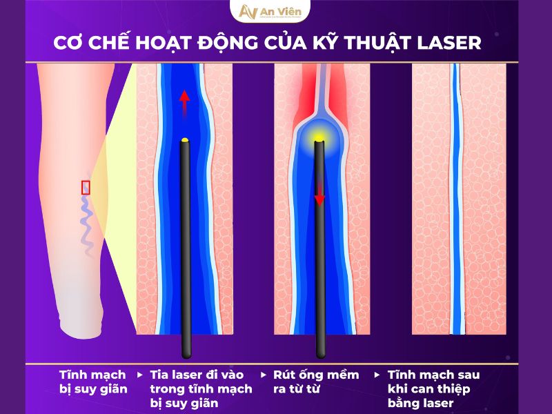 đốt laser suy tĩnh mạch chân