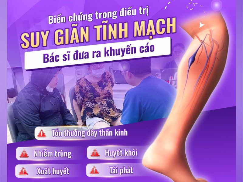 giãn tĩnh mạch có nên đi bộ không