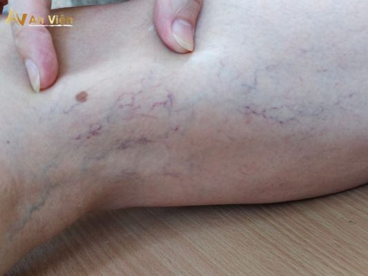 giãn tĩnh mạch mạng nhện