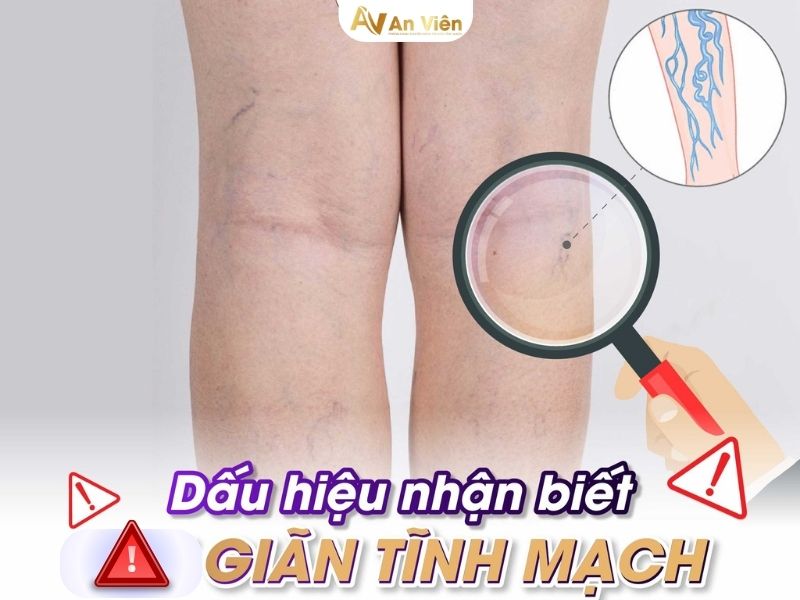giãn tĩnh mạch nhẹ