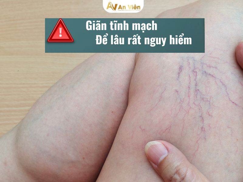 giãn tĩnh mạch nhẹ