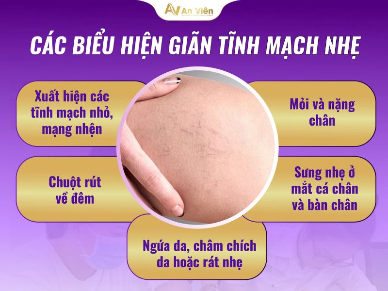giãn tĩnh mạch nhẹ