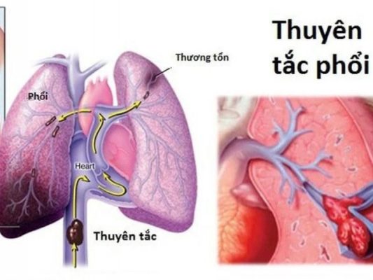 giãn tĩnh mạch phổi