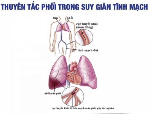 giãn tĩnh mạch phổi