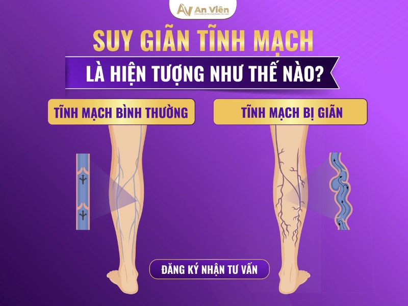 gối chống suy giãn tĩnh mạch có tốt không