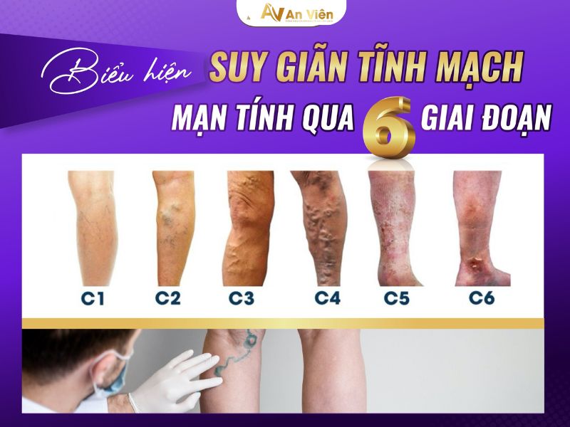 kem bôi giãn tĩnh mạch loại nào tốt nhất