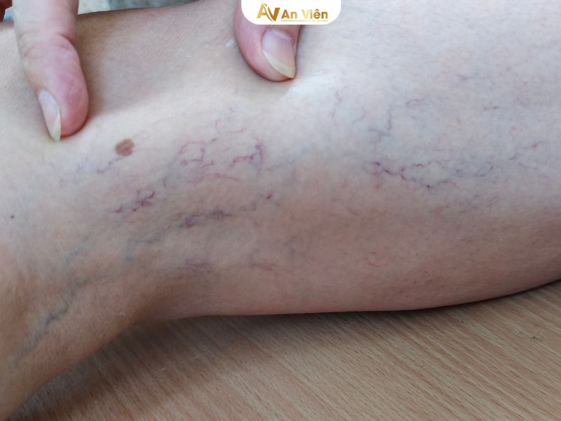 kem bôi giãn tĩnh mạch loại nào tốt nhất