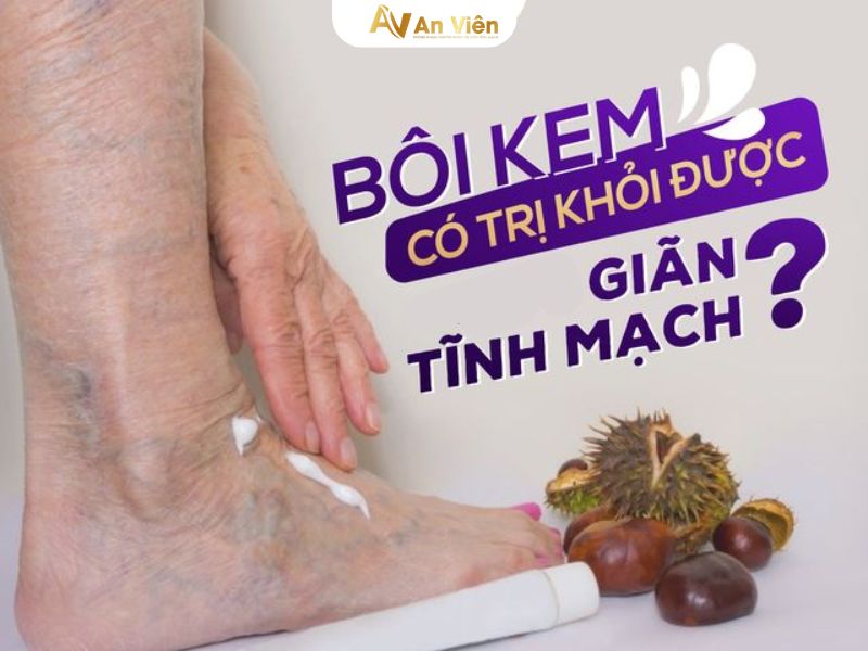 kem bôi giãn tĩnh mạch loại nào tốt nhất