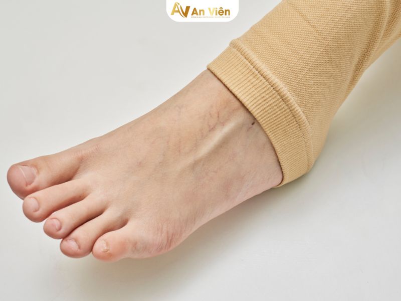 quần giãn tĩnh mạch