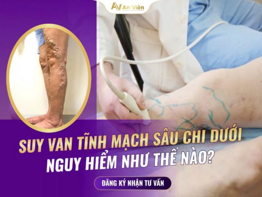 suy van tĩnh mạch chi dưới
