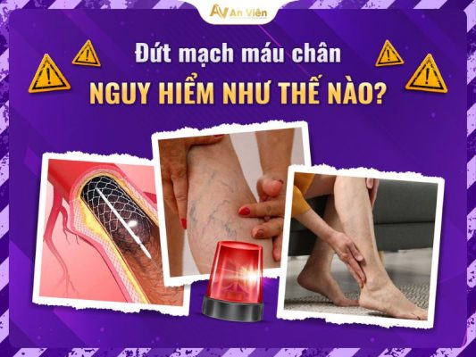 suy van tĩnh mạch sâu chi dưới