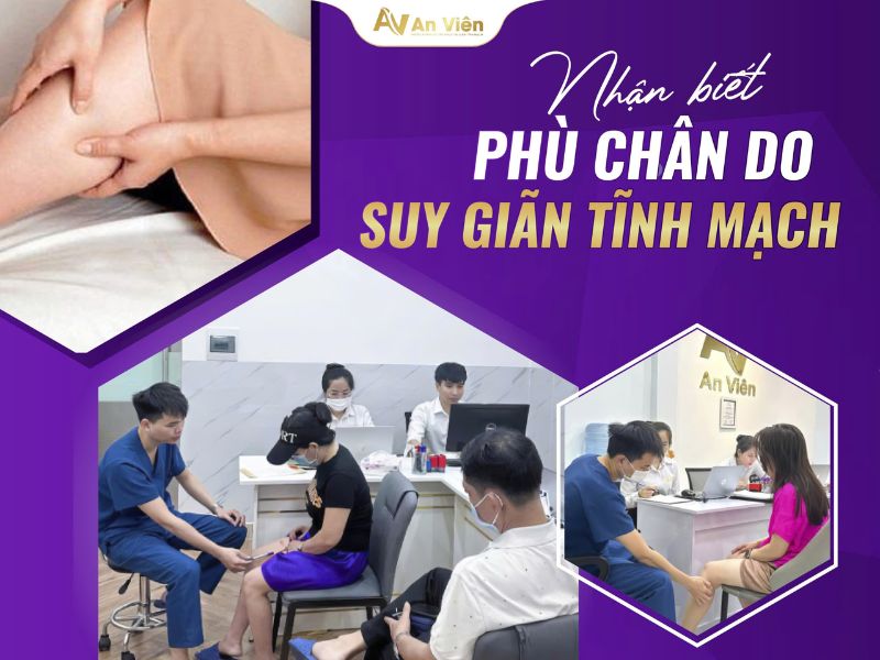 triệu chứng suy giãn tĩnh mạch