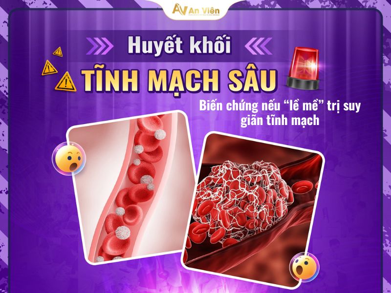 triệu chứng suy giãn tĩnh mạch