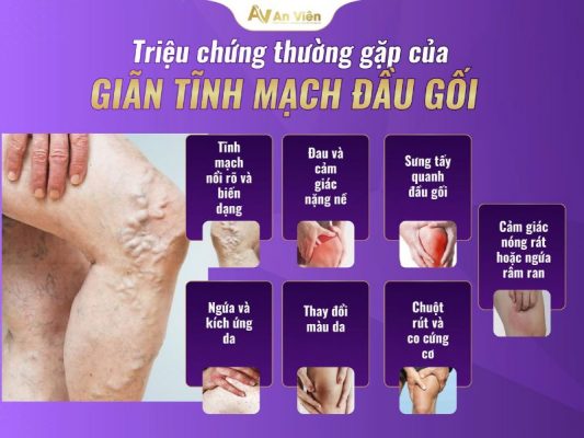 cách điều trị suy giãn tĩnh mạch sâu