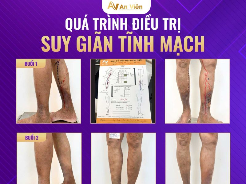 điều trị suy giãn tĩnh mạch nông chi dưới