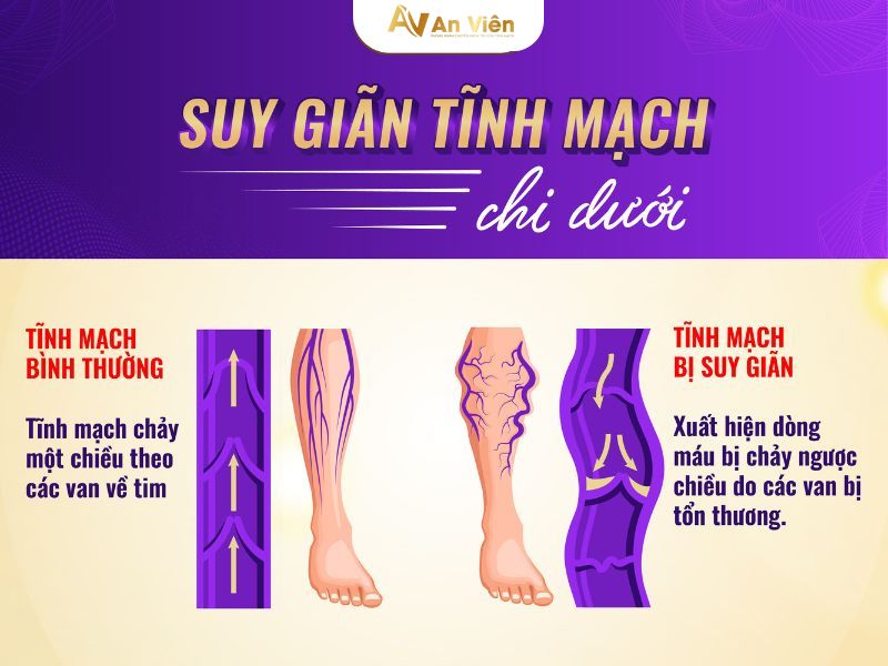 điều trị suy giãn tĩnh mạch nông chi dưới