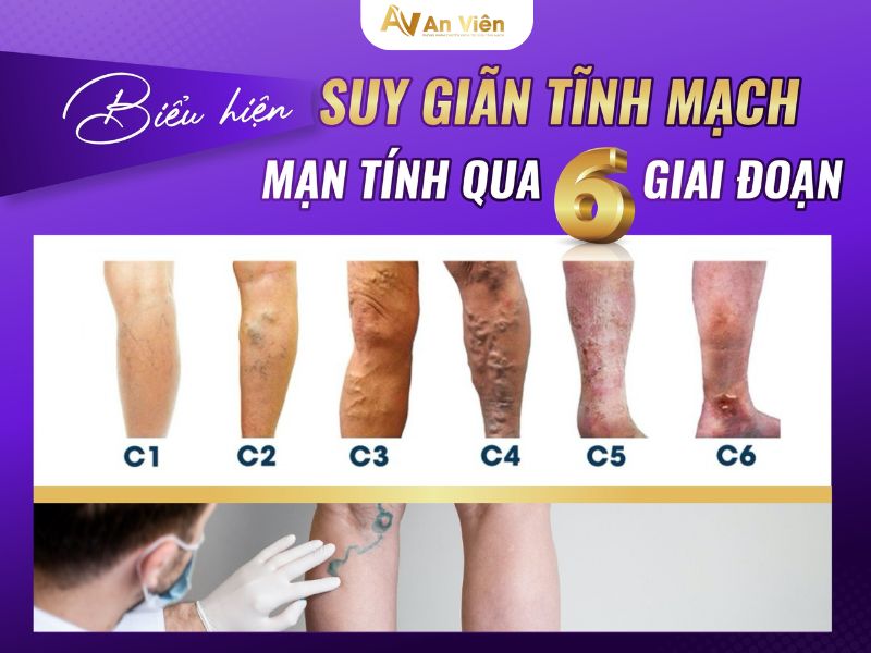 điều trị suy giãn tĩnh mạch nông chi dưới