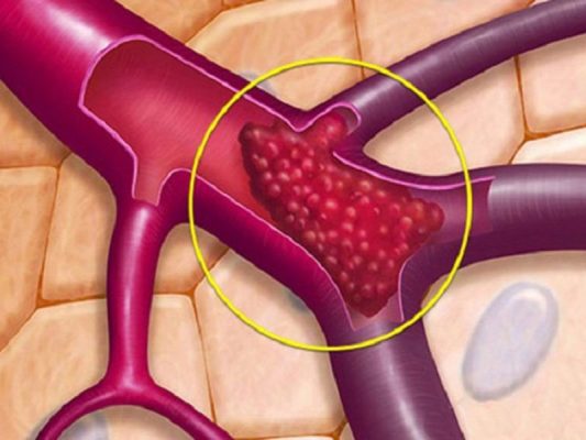giãn tĩnh mạch buồng trứng