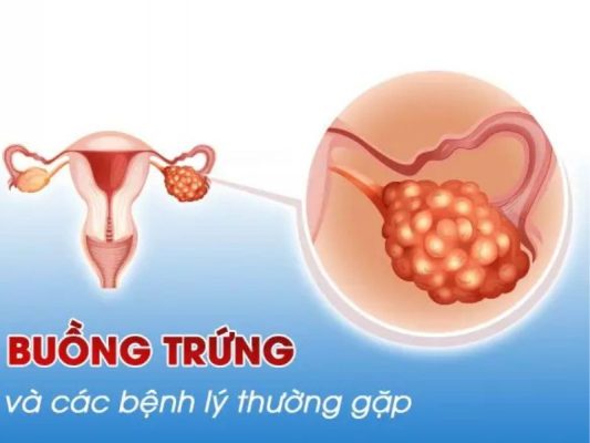 giãn tĩnh mạch buồng trứng
