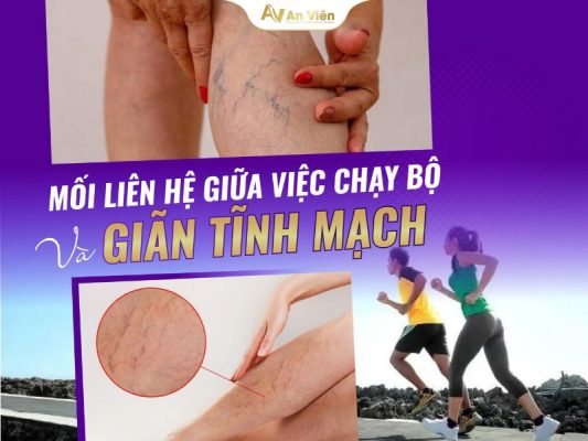 giãn tĩnh mạch có chạy bộ được không