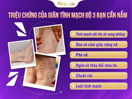 giãn tĩnh mạch độ 3