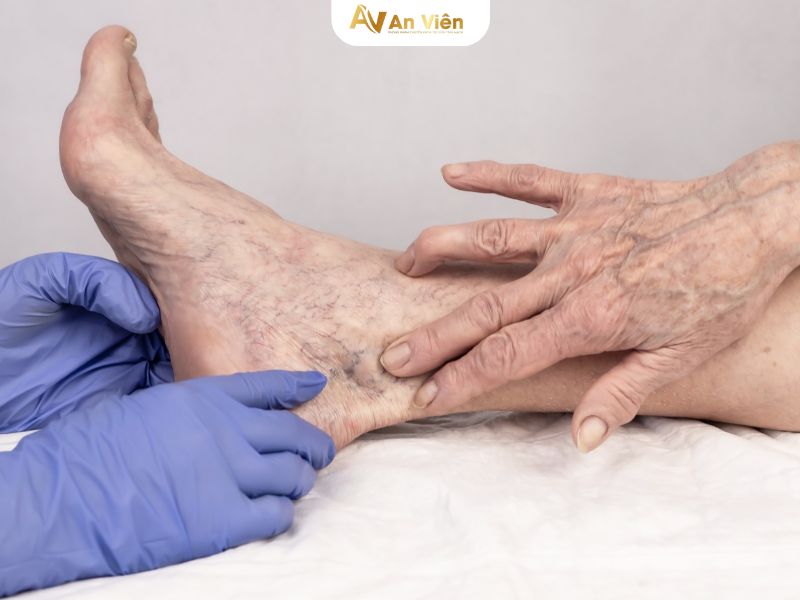 giãn tĩnh mạch mắt cá chân