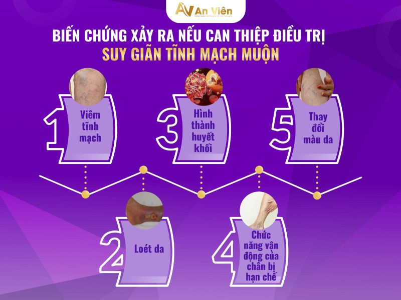 giãn tĩnh mạch mắt cá chân