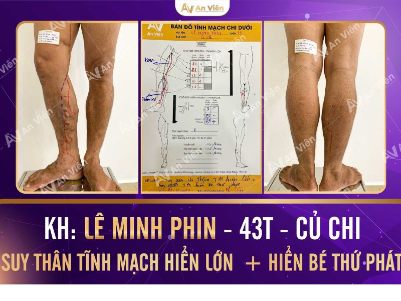 giãn tĩnh mạch mắt cá chân