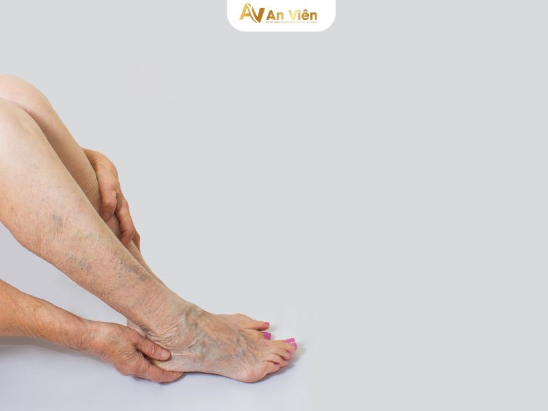 giãn tĩnh mạch mắt cá chân