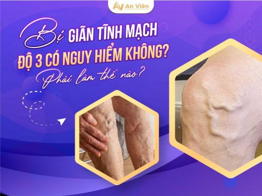 giãn tĩnh mạch ngoại biên