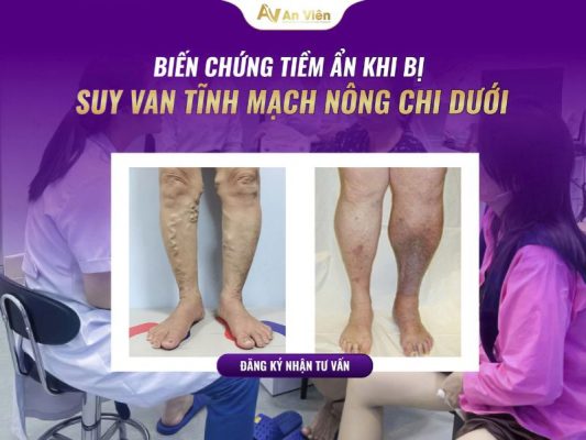 giãn tĩnh mạch ngoại biên