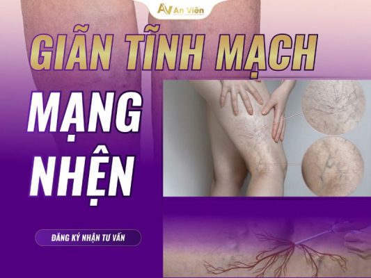 giãn tĩnh mạch ngoại biên