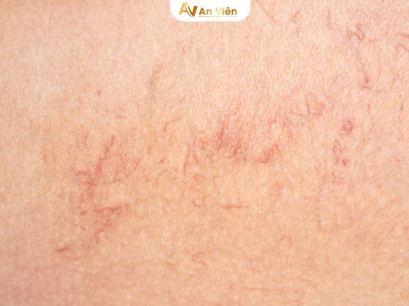giãn tĩnh mạch ở mặt trẻ em