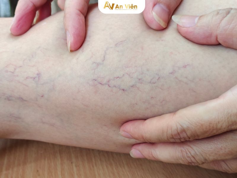 giãn tĩnh mạch sau sinh